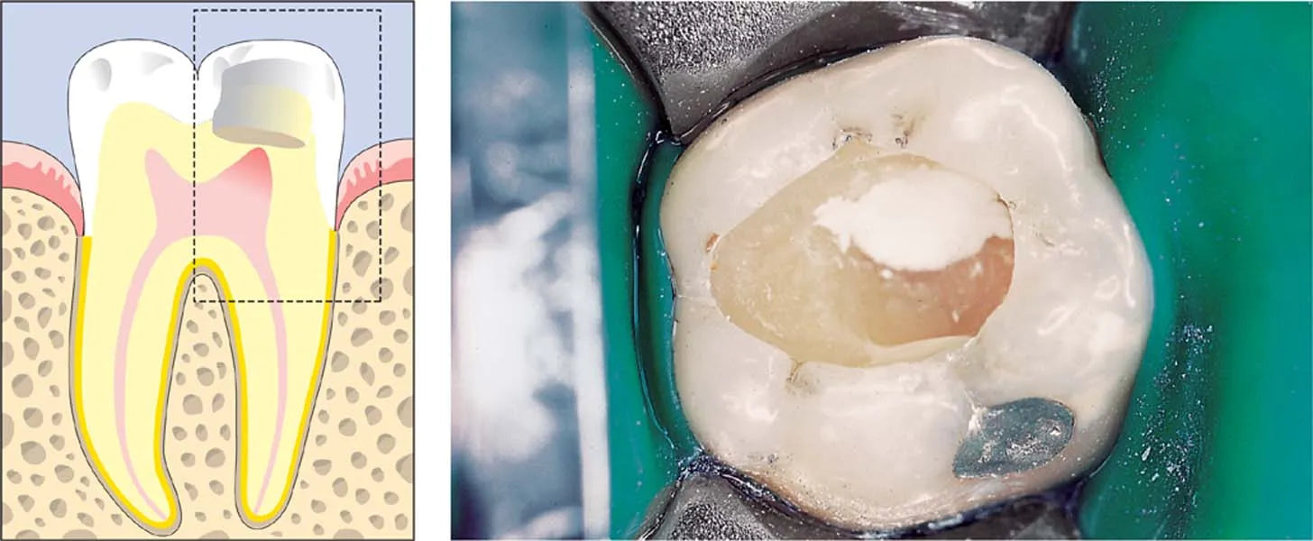 SafeEndo ReGlass LC mdental