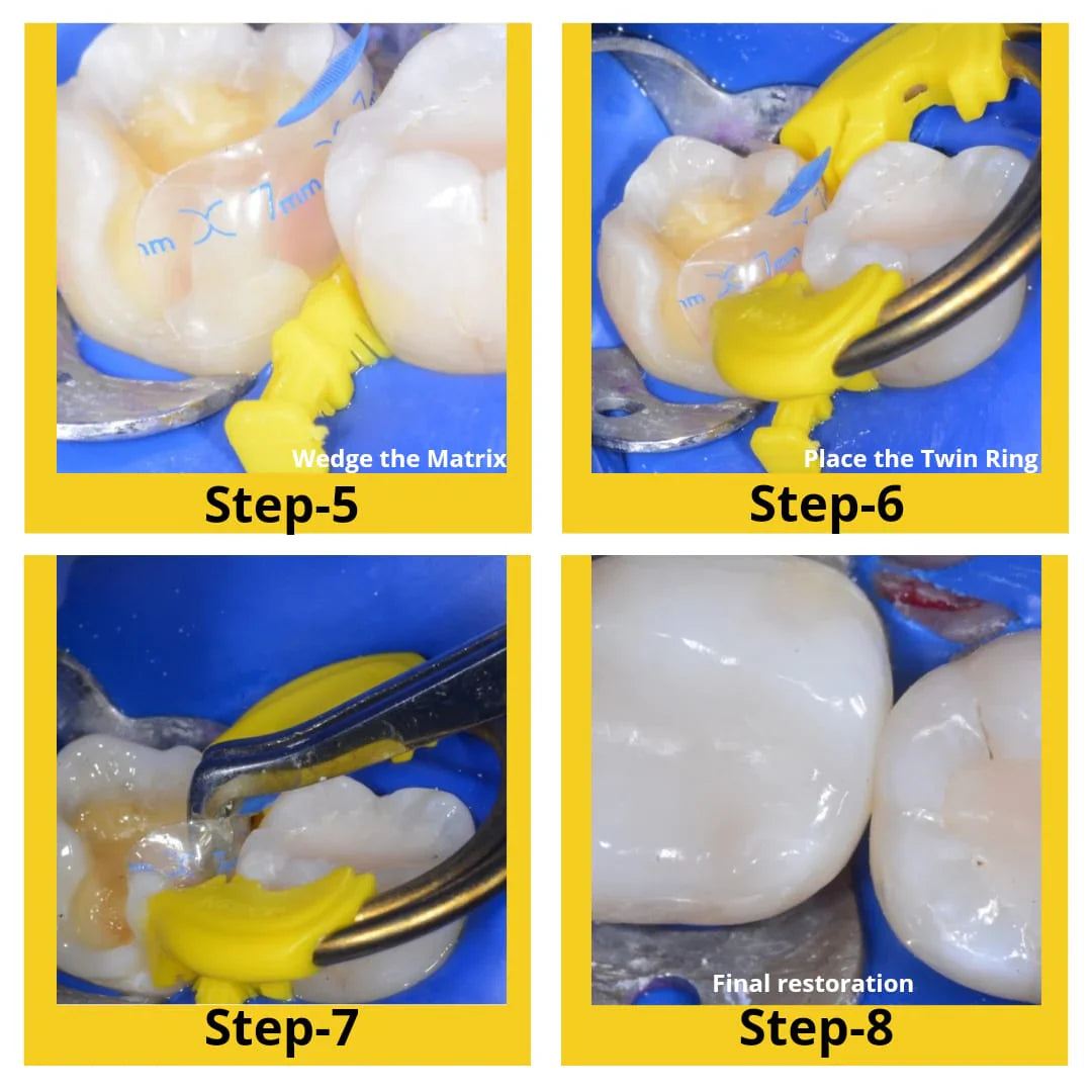 Bioclear Evolve Matrices Mini Kit mdental