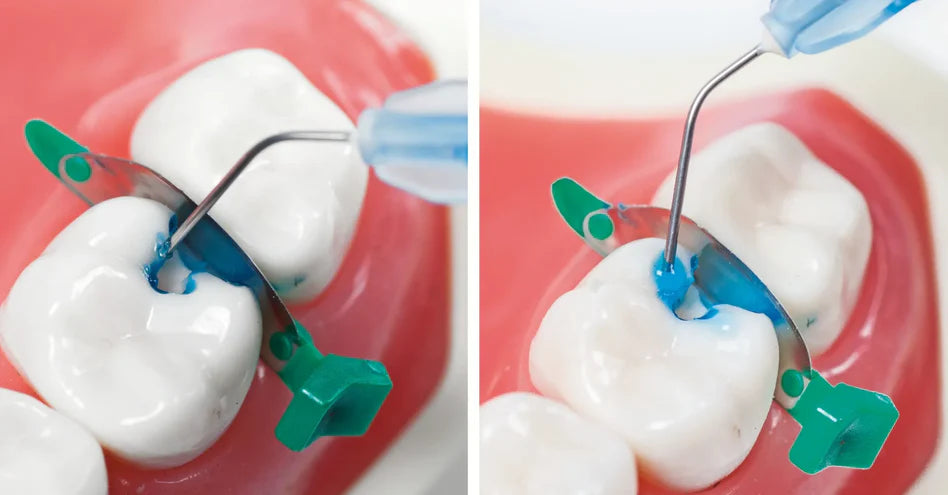 Safe Endo Smart Etch mdental