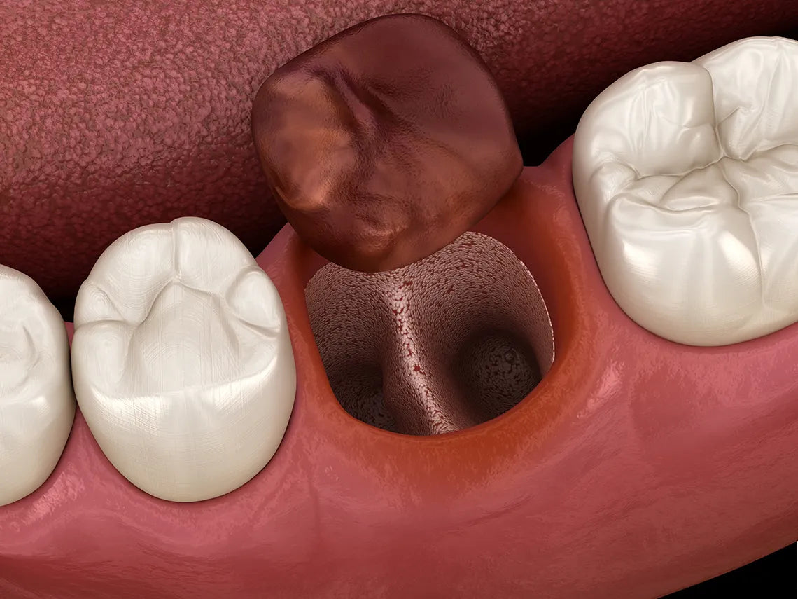 SafeEndo Socket Cure mdental