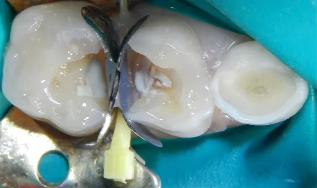 SafeEndo ReGlass LC mdental