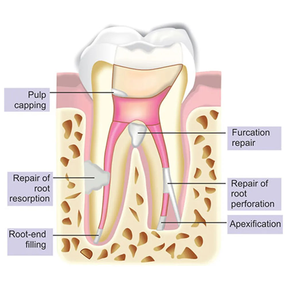 SafeEndo Biostructure MTA Putty mdental