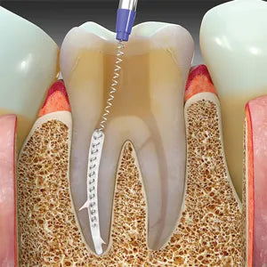 SafeEndo EugeSeal mdental
