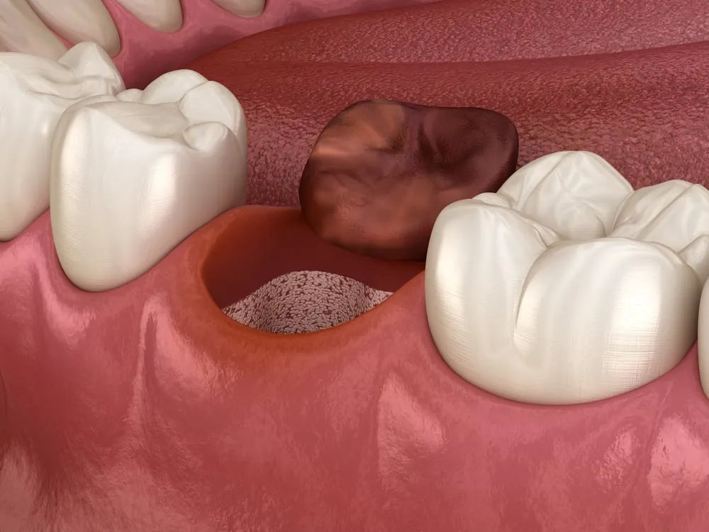 SafeEndo Socket Cure mdental